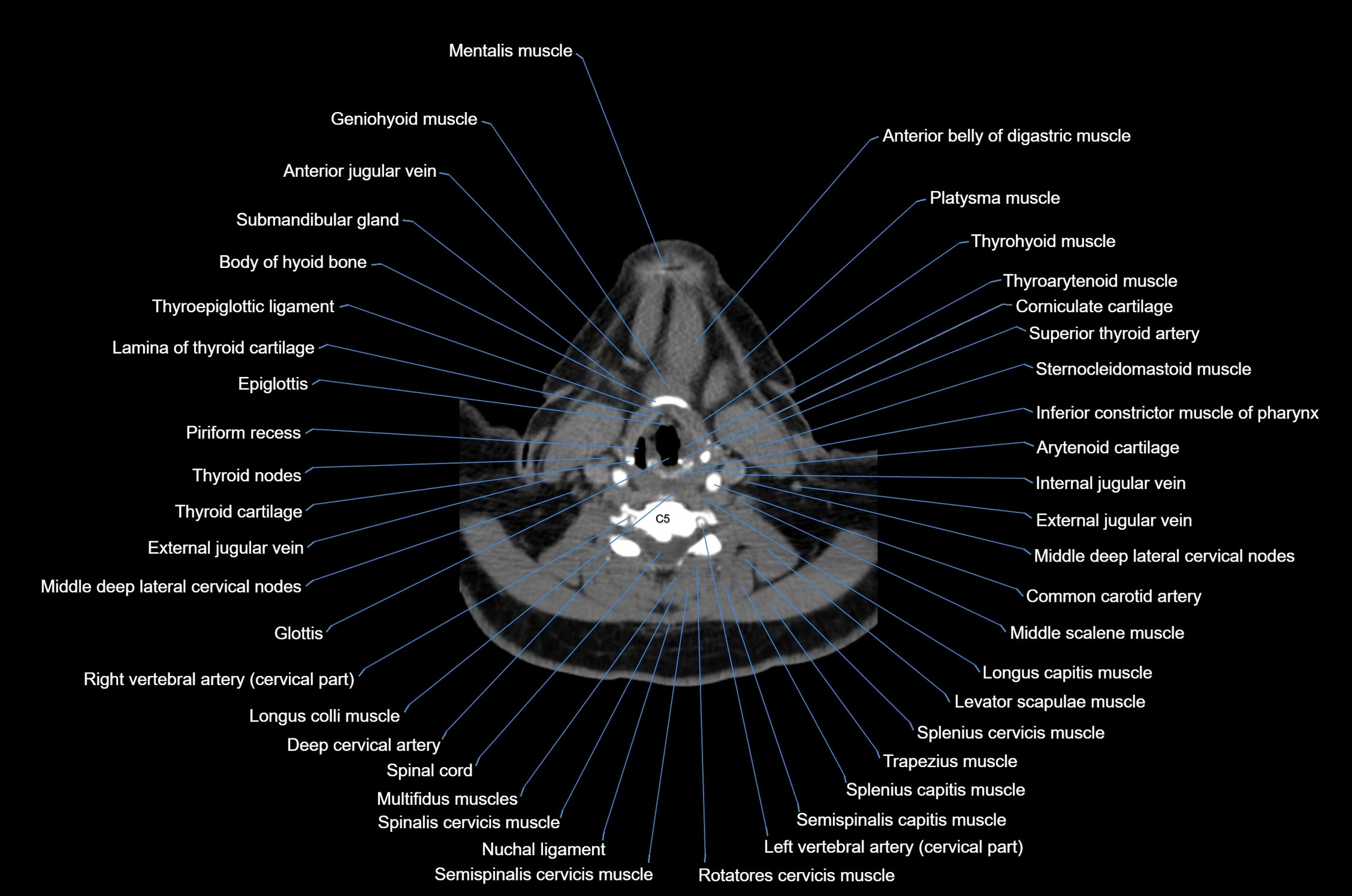 CT Neck axial cross sectional anatomy radiology image-img-00001-00041.webp